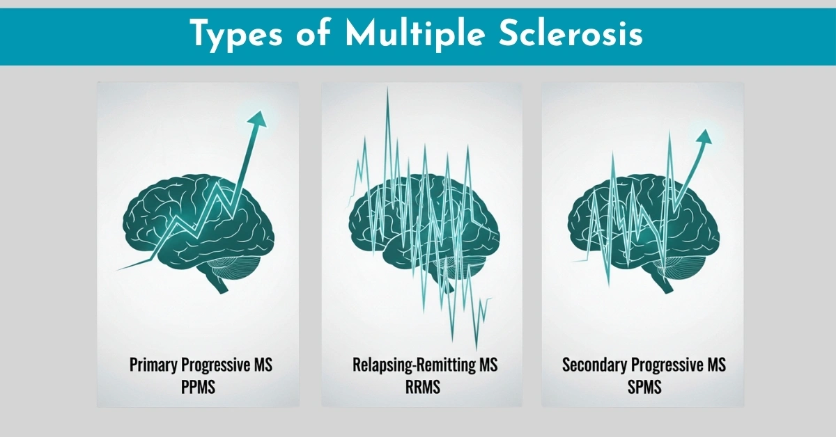Types of Multiple Sclerosis